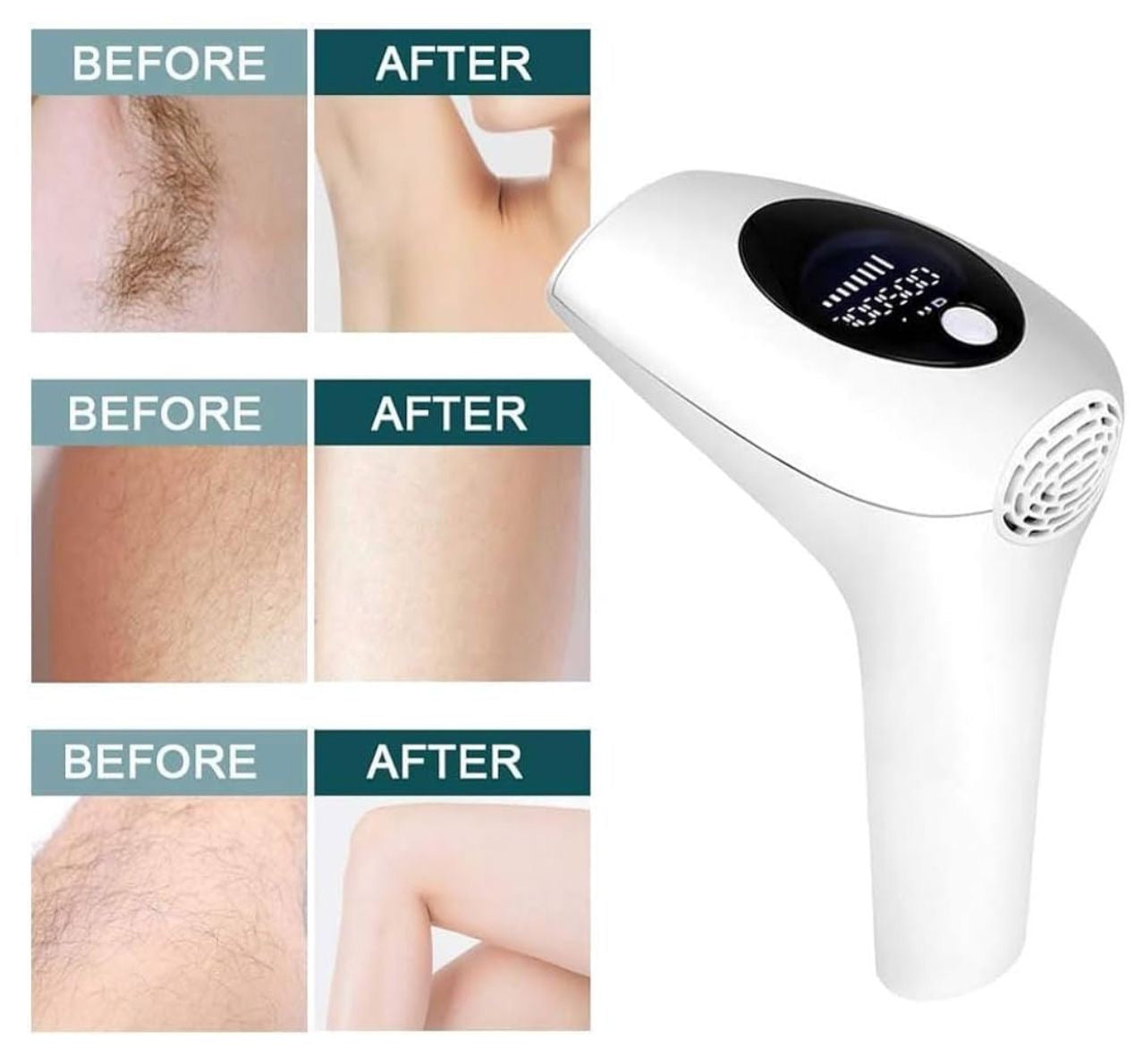 Hair Removal Laser Intense Home use